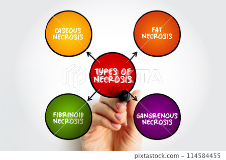 Types of Necrosis (death of body tissue) mind map text concept for presentations and reports Types of Necrosis (death of body tissue) mind map text concept for presentations and reports 114584455