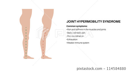 Joint hypermobility poster Joint hypermobility poster 114584880