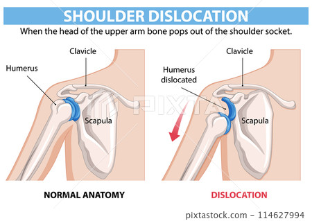 Shoulder Dislocation Anatomy Illustration 114627994