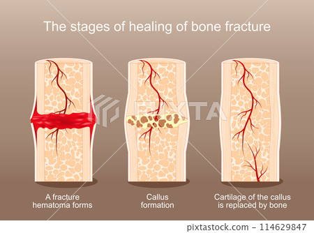 Healing of bone fracture. Healing of bone fracture. 114629847