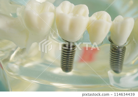 Dental implant, artificial tooth roots into jaw, root canal of dental treatment, gum disease, teeth model for dentist studying about dentistry. 114634439