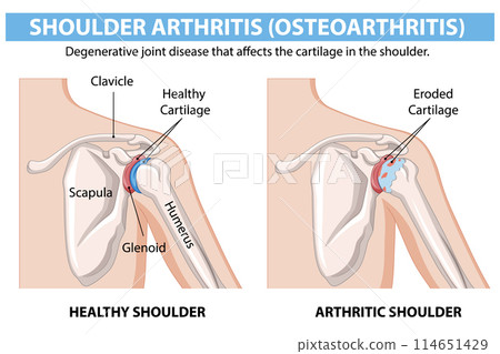 Shoulder Arthritis Comparison Illustration Shoulder Arthritis Comparison Illustration 114651429