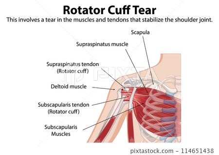 Rotator Cuff Tear Illustration 114651438
