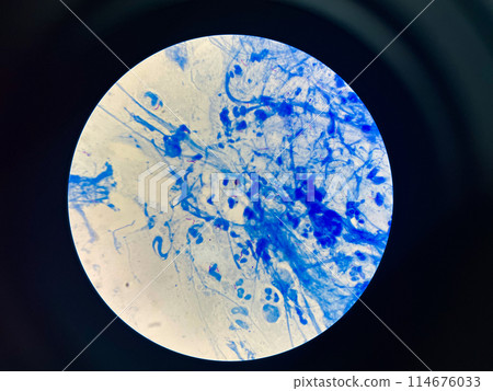 AFB 3+ sample collect sputum. AFB 3+ sample collect sputum. 114676033