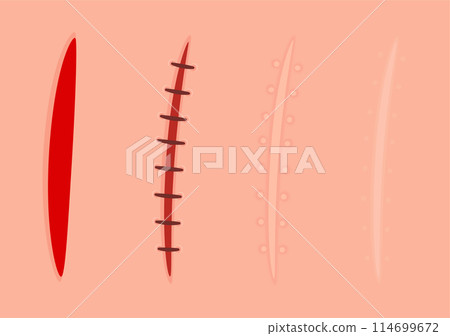 Skin scar healing process 114699672