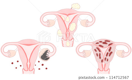 子宮肌瘤、子宮肌腺症、子宮內膜異位症的比較 簡單易懂的圖解 114712567