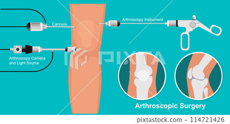 Arthroscopy medical treatment surgery. 114721426