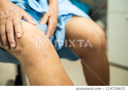 Asian elderly woman patient show her scars surgical total knee joint replacement Suture wound surgery arthroplasty on bed in hospital. Asian elderly woman patient show her scars surgical total knee joint replacement Suture wound surgery arthroplasty on bed in hospital. 114726655