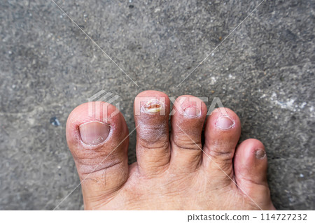 Nail falls off 114727232