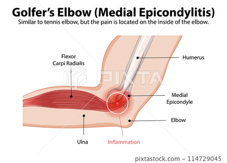 Golfer's Elbow Anatomy Illustration 114729045