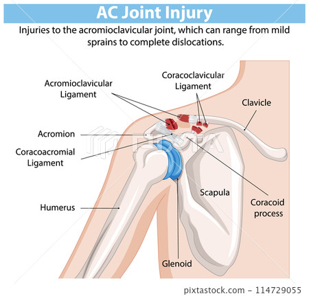AC Joint Injury Diagram 114729055