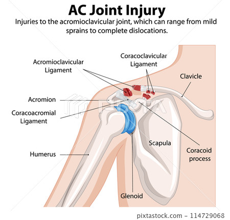 AC Joint Injury Diagram 114729068