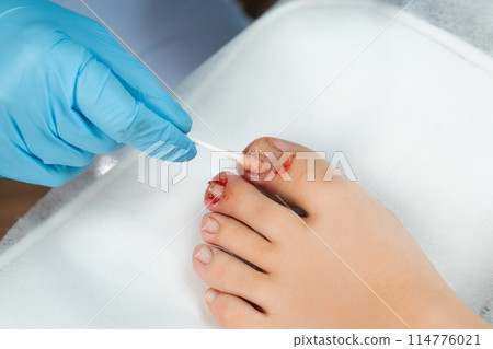Close up podologist treats the nail with an antifungal agent.  114776021