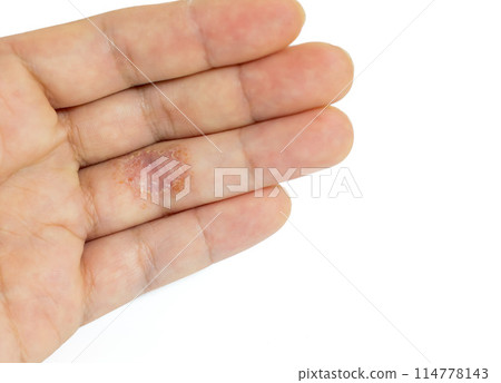 左手無名指上有濕疹 114778143