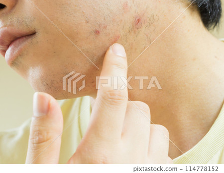 Man concerned about eczema on his neck and chin Man concerned about eczema on his neck and chin 114778152