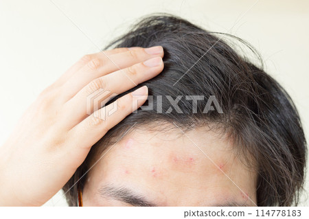 A man suffering from eczema on his forehead A man suffering from eczema on his forehead 114778183