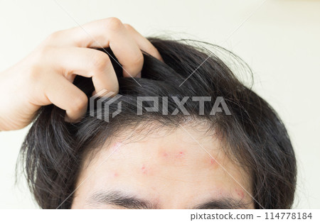 額頭患有濕疹的男人 額頭患有濕疹的男人 114778184