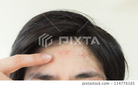 Image of a man suffering from eczema on his forehead Image of a man suffering from eczema on his forehead 114778185