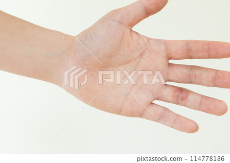Hand eczema on the ring finger Hand eczema on the ring finger 114778186