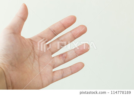 手無名指上有濕疹 114778189