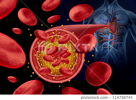 atherosclerosis Artery Plaque atherosclerosis Artery Plaque 114780745
