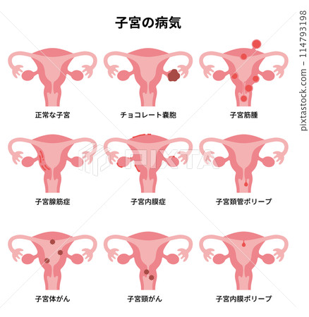 2024人體-子宮疾病圖解 114793198