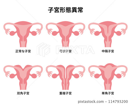 2024人體-子宮形態異常圖 114793200