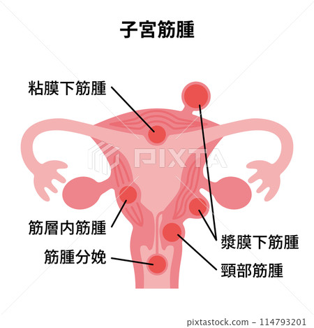 2024 人體-子宮肌瘤圖 114793201