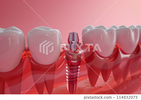 The concept of dental implants. A 3D rendering showing a dental implant placed between teeth The concept of dental implants. A 3D rendering showing a dental implant placed between teeth 114832073