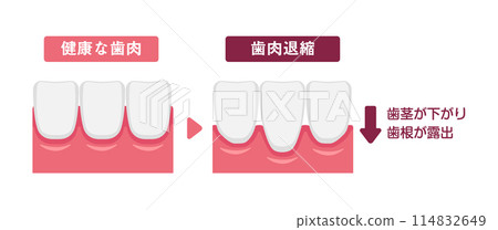 Illustration comparing healthy gums and gingival recession (receding gums) 114832649