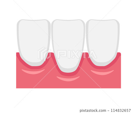 Gingival recession (receding gums) Vector illustration 114832657