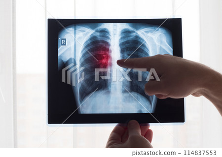 Lung radiography concept. Radiology doctor examining at chest x ray film of patient Lung Cancer or Pneumonia. Virus and bacteria infected the Human lungs. Patient with Lung Cancer or Pneumonia Lung radiography concept. Radiology doctor examining at chest x ray film of patient Lung Cancer or Pneumonia. Virus and bacteria infected the Human lungs. Patient with Lung Cancer or Pneumonia 114837553