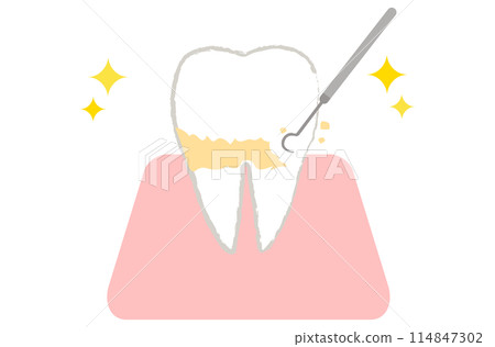 Teeth to be plaque removed and scaled 114847302