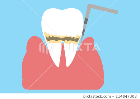 牙周病/牙周袋檢查中等 牙周病/牙周袋檢查中等 114847308