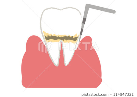 Periodontal disease and periodontal pocket examination: Moderate 114847321