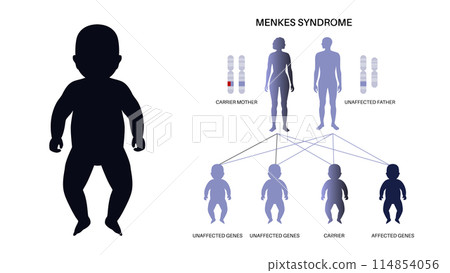 Menkes syndrome poster 114854056