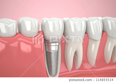 The concept of dental implants. A 3D rendering showing a dental implant placed between teeth The concept of dental implants. A 3D rendering showing a dental implant placed between teeth 114855514