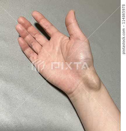 Ganglion 114865978