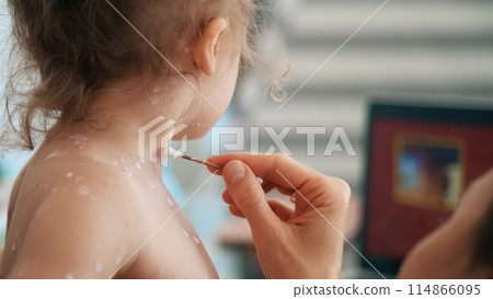Mother treating her little daughter with varicella or chickenpox at home 114866095