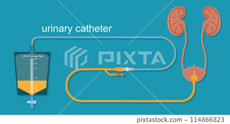 Urinary catheter in the body. Urinary catheter in the body. 114866823
