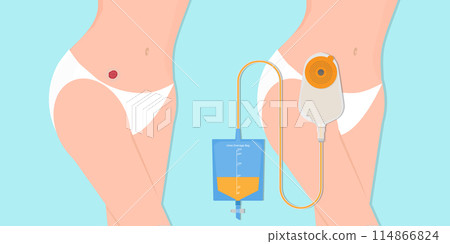 Stoma and colostomy isolated on background. Stoma and colostomy isolated on background. 114866824