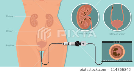 Laparoscope minimally invasive surgery for kidney painful treatment stone removal. Laparoscope minimally invasive surgery for kidney painful treatment stone removal. 114866843