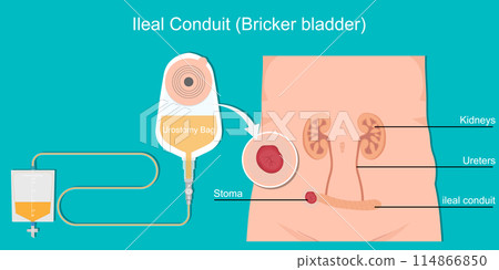 Ileal conduit or Bricker Bladder. 114866850