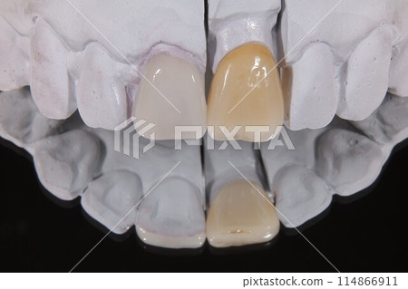讓我們去看牙醫，獲得美麗的陶瓷牙齒。 114866911