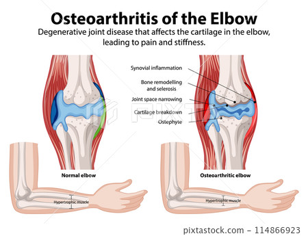 Osteoarthritis of the Elbow 114866923