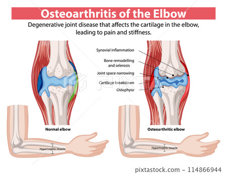 Osteoarthritis of the Elbow 114866944