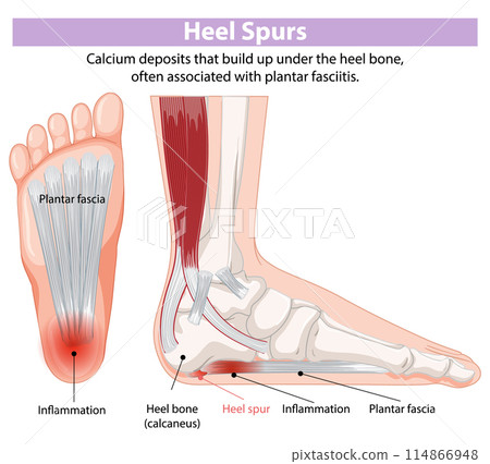 Heel Spurs and Plantar Fasciitis 114866948
