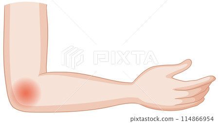 Elbow Pain Illustration 114866954