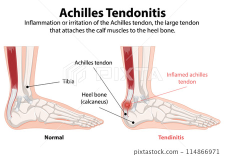 Achilles Tendonitis Illustration 114866971