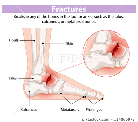 Foot and Ankle Fracture Diagram 114866972